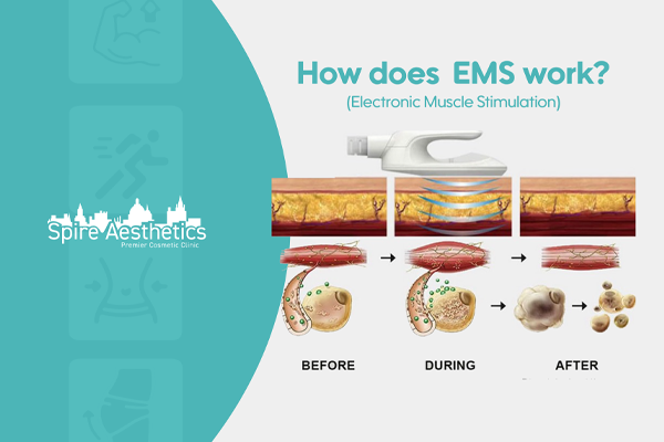 EMS treatment for post pregnancy weight loss treatment Kingshurst