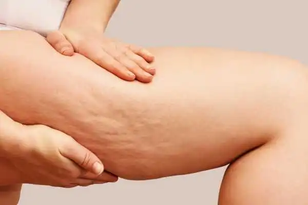 Image of woman showing leg with cellulite Kingshurst