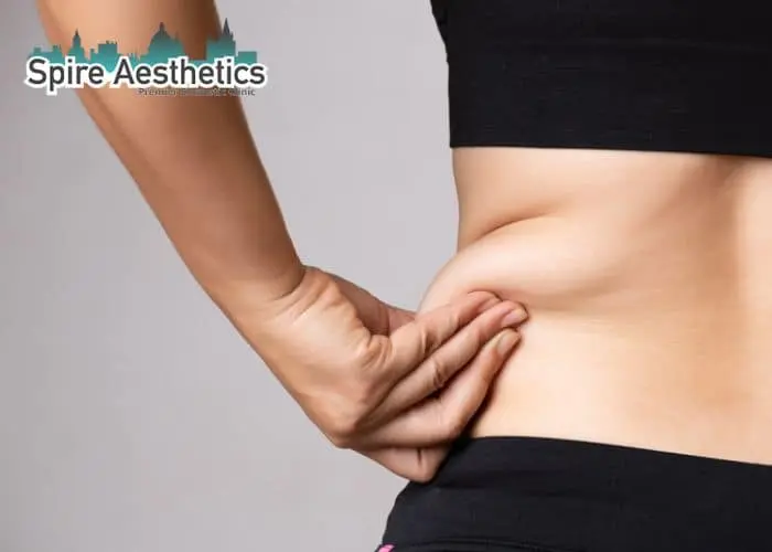 Image of woman pinching fat on their hips Kingshurst. Fat Freezing treatment