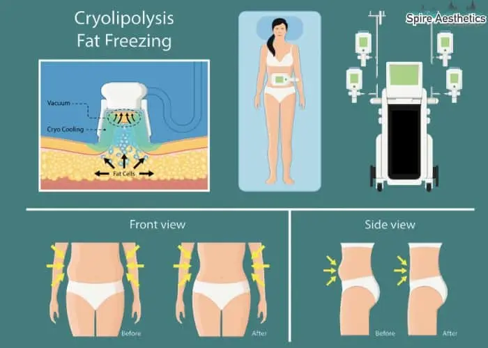 Fat freezing treatment Kingshurst benefits for competitions to remove stubborn fat deposits.