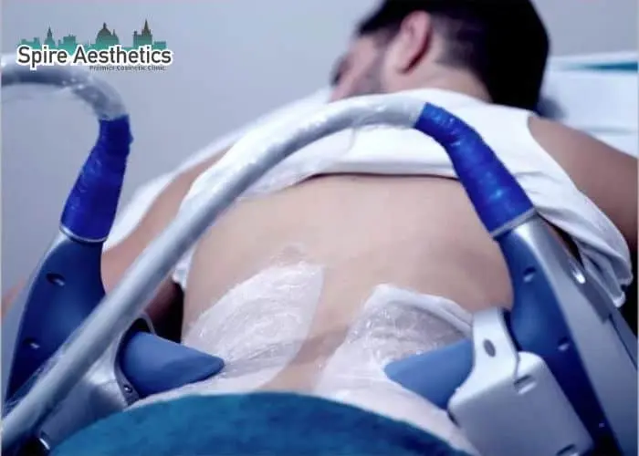 Man having fat freezing treatment done on love handles before a competitions Kingshurst to create a sculpted look.