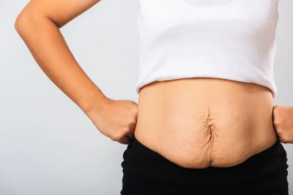 Image of a woman's stomach after weight loss with sagging skin following a gastric band Kingshurst